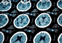 Une nouvelle étude démontre la présence « extrêmement élevée » d’aluminium dans le cerveau des patients autistes