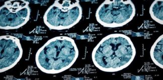 Une nouvelle étude démontre la présence « extrêmement élevée » d’aluminium dans le cerveau des patients autistes
