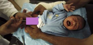 La circoncision provoque de lourdes conséquences psychologiques