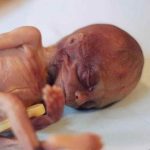 babies after abortion 50